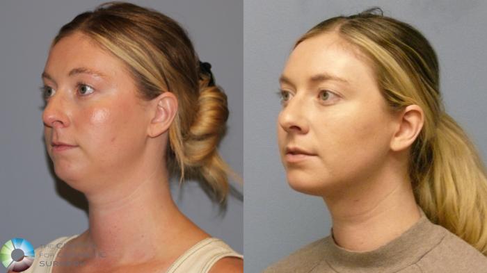 Before & After Neck Lift Case 11921 Left Oblique in Denver and Colorado Springs, CO