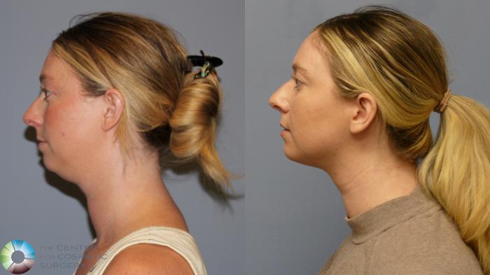 Before & After Neck Lift Case 11921 Left Side in Denver and Colorado Springs, CO