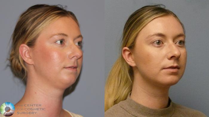 Before & After Neck Lift Case 11921 Right Oblique in Denver and Colorado Springs, CO