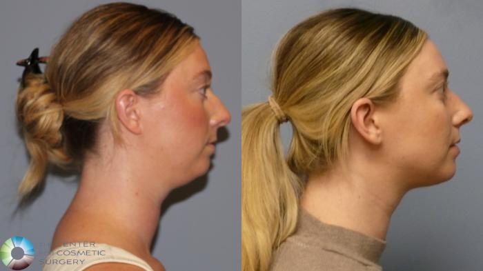 Before & After Neck Lift Case 11921 Right Side in Denver and Colorado Springs, CO