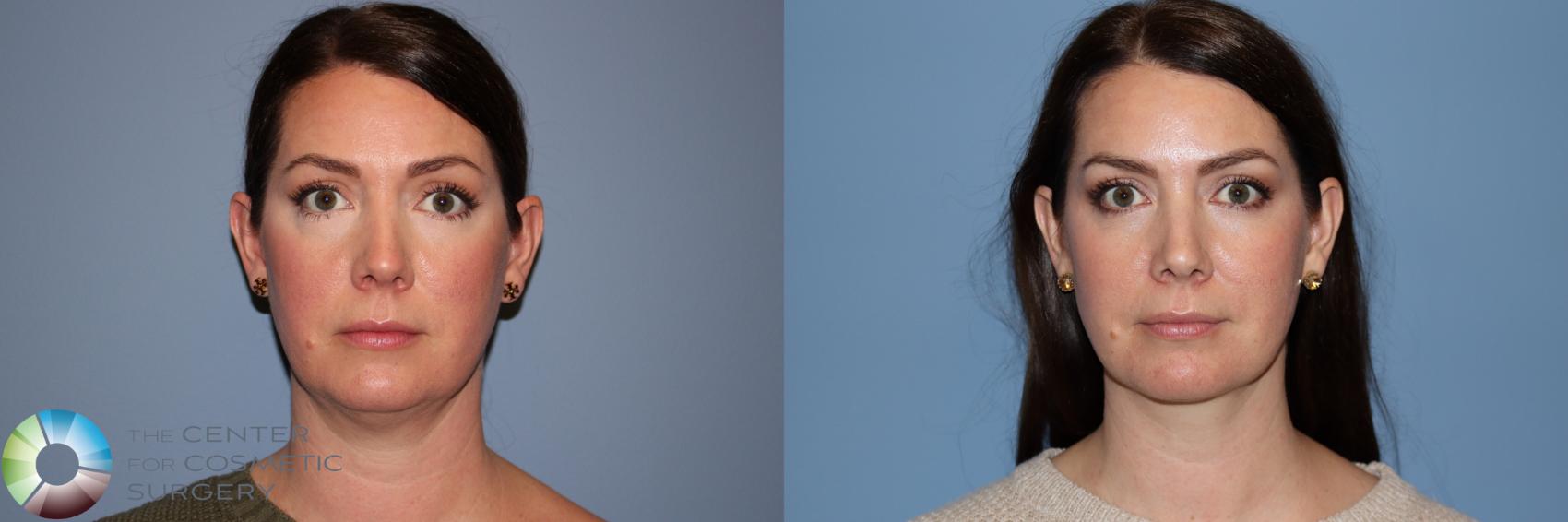 Before & After Neck Lift Case 11953 Front in Denver and Colorado Springs, CO