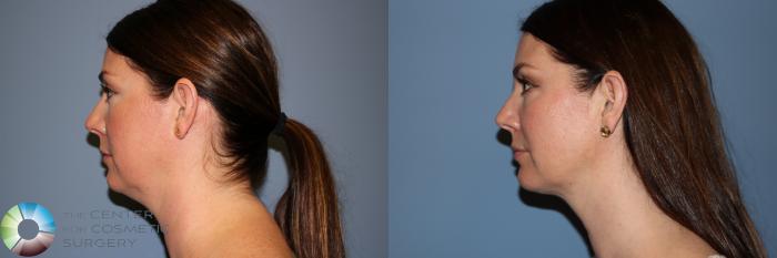 Before & After Neck Lift Case 11953 Left Side in Denver and Colorado Springs, CO