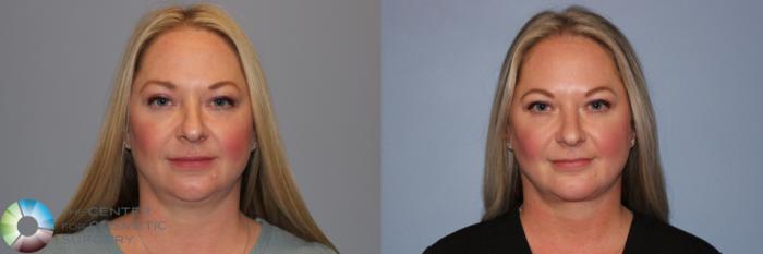 Before & After Neck Lift Case 11957 Front in Denver and Colorado Springs, CO
