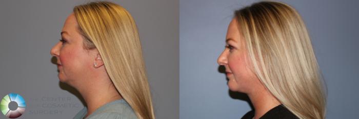 Before & After Neck Lift Case 11957 Left Side in Denver and Colorado Springs, CO