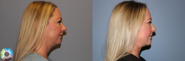 Before & After Neck Lift Case 11957 Right Side in Denver and Colorado Springs, CO