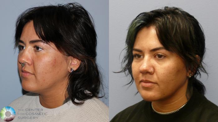 Before & After Neck Lift Case 11970 Left Oblique in Denver and Colorado Springs, CO