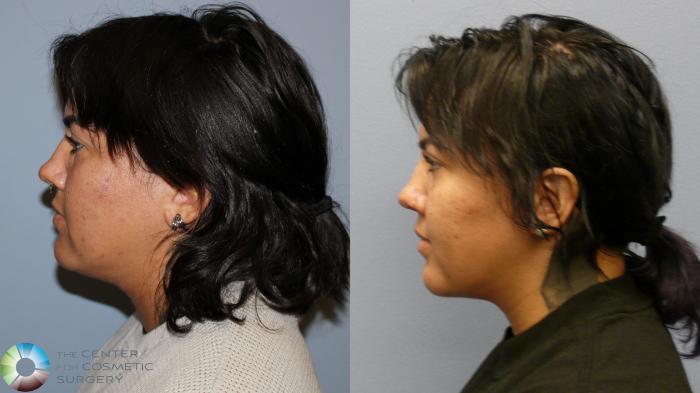 Before & After Neck Lift Case 11970 Left Side in Denver and Colorado Springs, CO