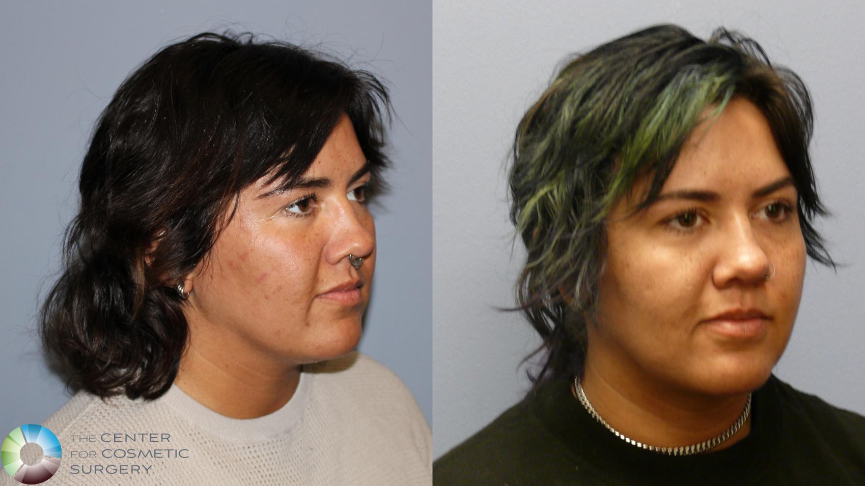 Before & After Neck Lift Case 11970 Right Oblique in Denver and Colorado Springs, CO