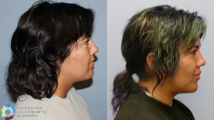 Before & After Neck Lift Case 11970 Right Side in Denver and Colorado Springs, CO