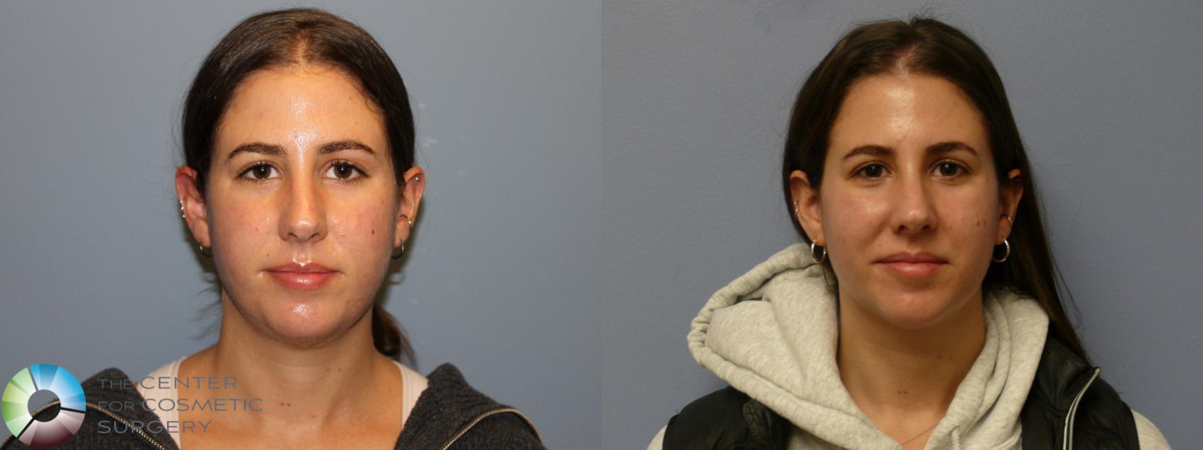Before & After Neck Lift Case 11972 Front in Denver and Colorado Springs, CO