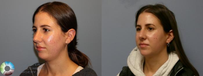 Before & After Neck Lift Case 11972 Left Oblique in Denver and Colorado Springs, CO