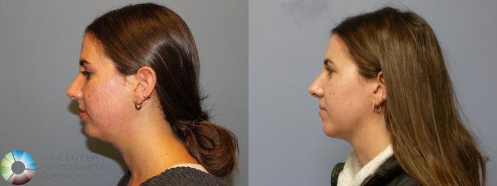 Before & After Neck Lift Case 11972 Left Side in Denver and Colorado Springs, CO