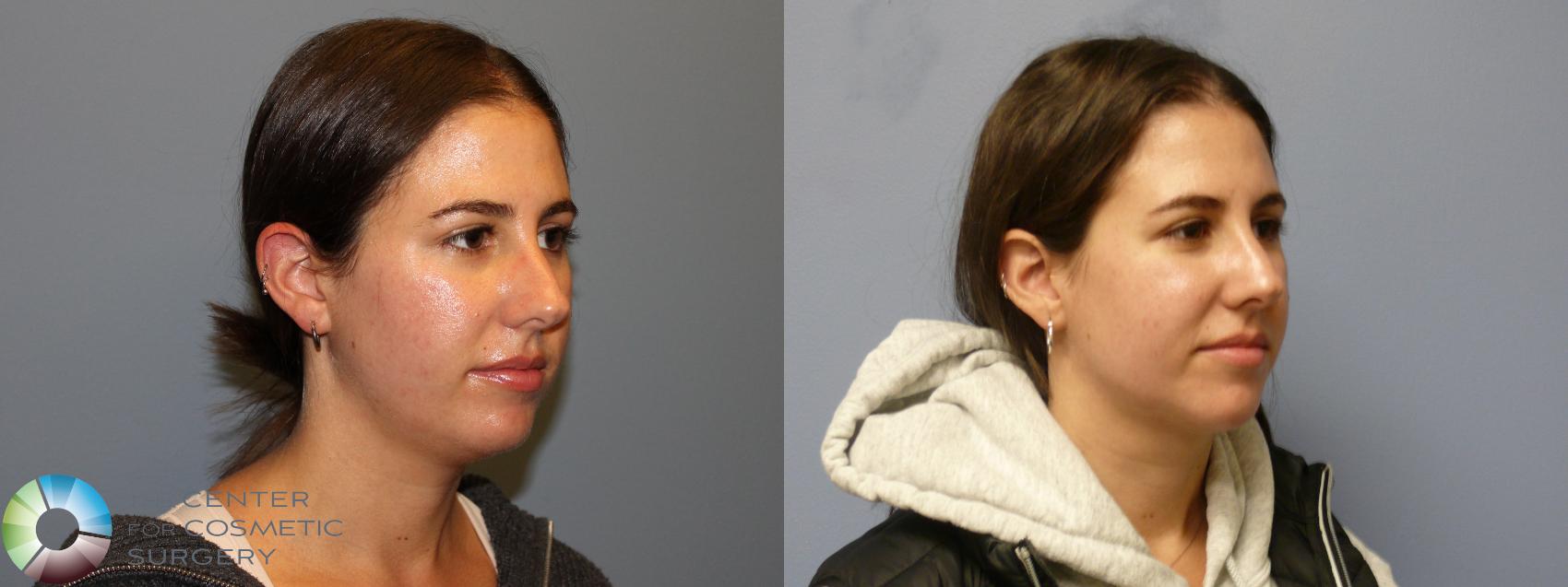 Before & After Neck Lift Case 11972 Right Oblique in Denver and Colorado Springs, CO