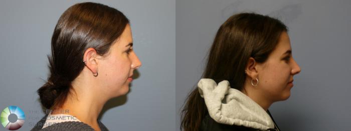 Before & After Neck Lift Case 11972 Right Side in Denver and Colorado Springs, CO
