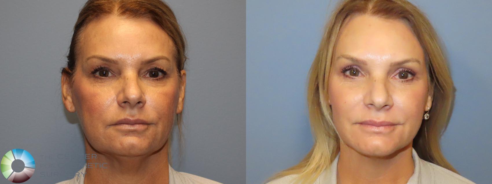 Before & After Neck Lift Case 11991 Front in Denver and Colorado Springs, CO