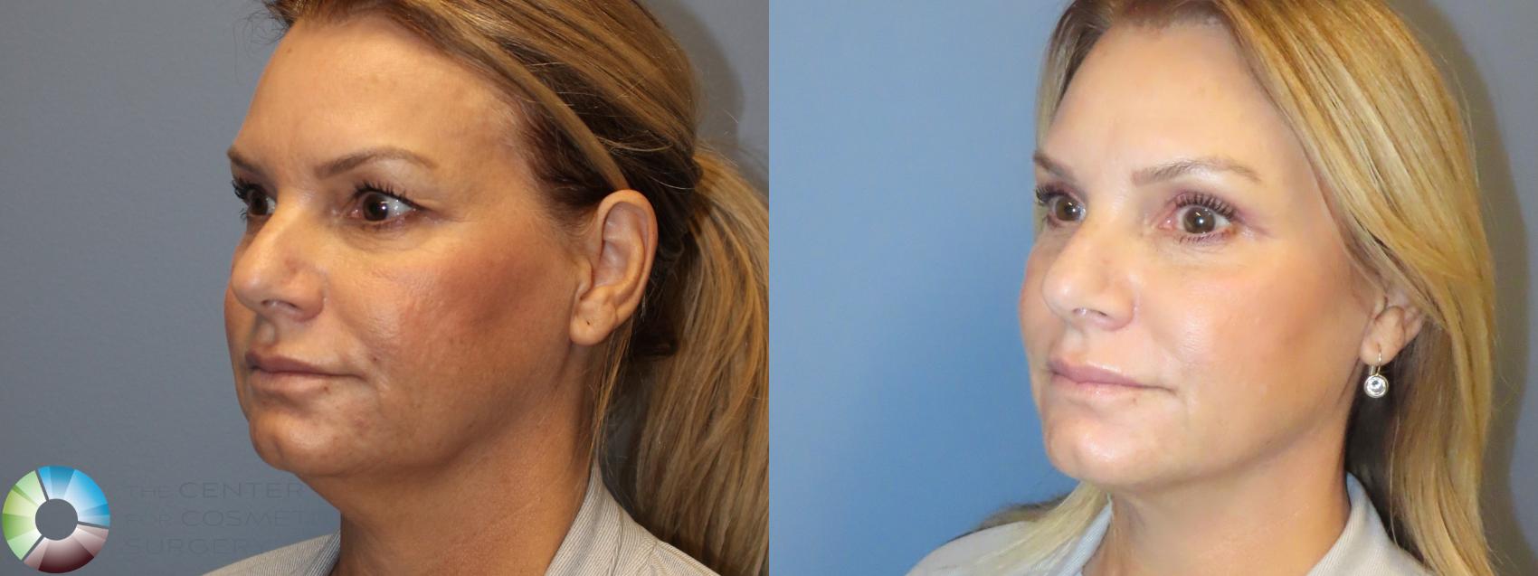 Before & After Neck Lift Case 11991 Left Oblique in Denver and Colorado Springs, CO