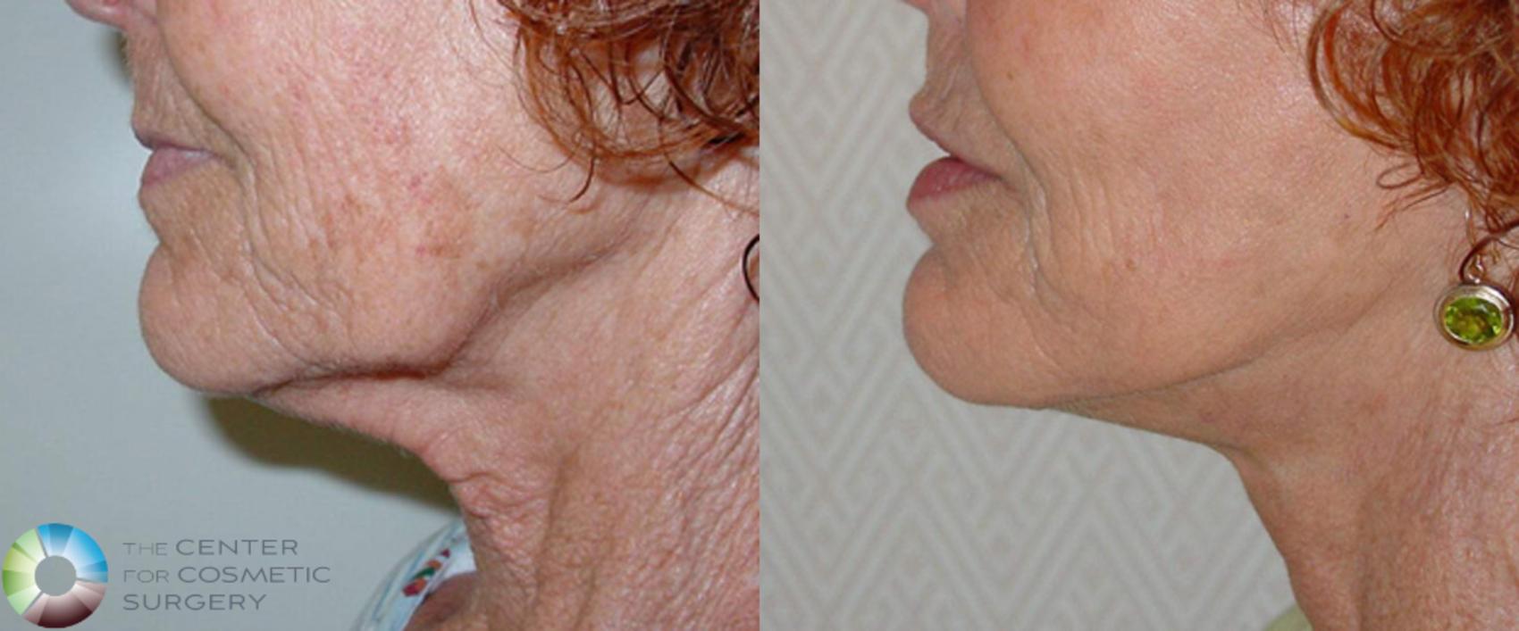 Before & After Neck Lift Case 509 View #1 in Denver and Colorado Springs, CO