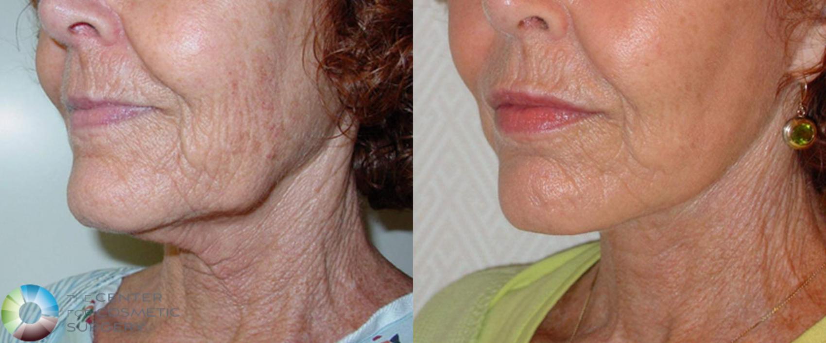 Before & After Neck Lift Case 509 View #2 View in Golden, CO