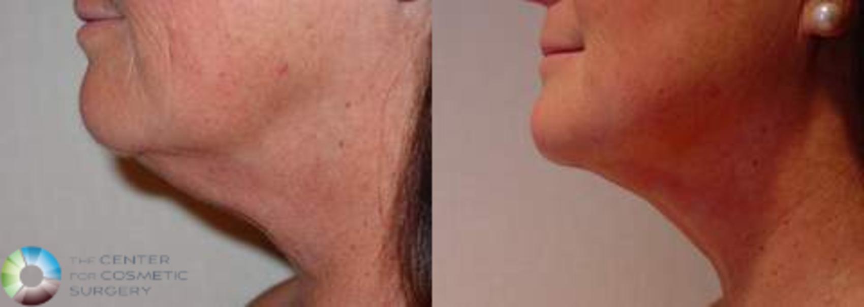 Before & After Neck Lift Case 625 View #1 in Denver and Colorado Springs, CO