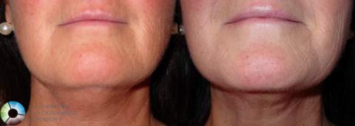 Before & After Neck Lift Case 625 View #2 View in Golden, CO