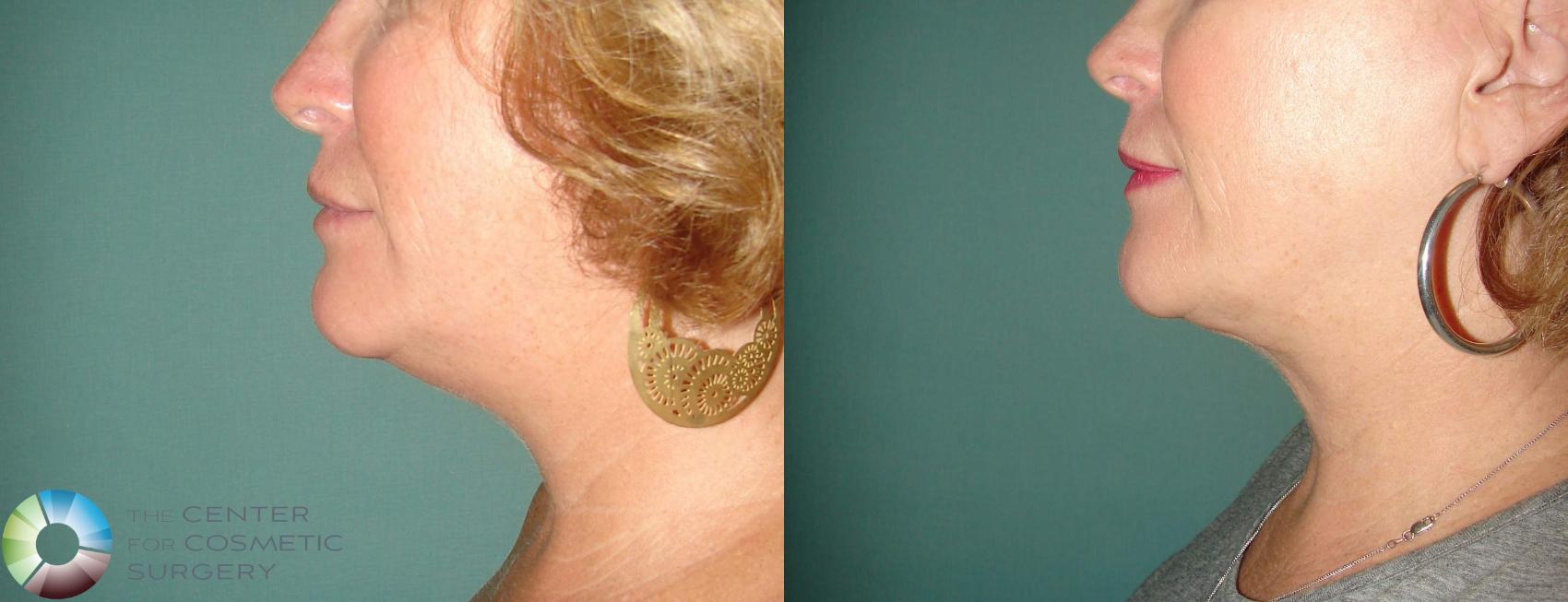 Before & After Neck Lift Case 650 View #1 in Denver and Colorado Springs, CO