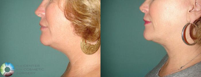 Before & After Neck Lift Case 650 View #1 View in Golden, CO