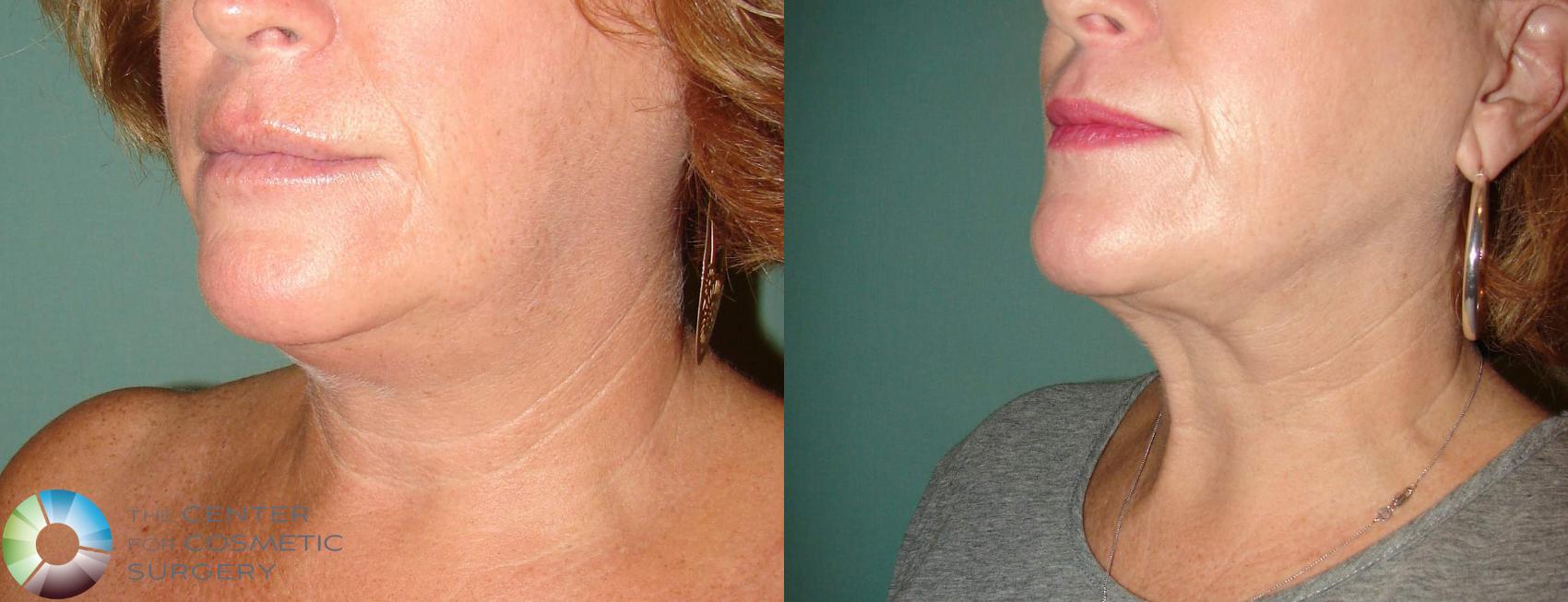 Before & After Neck Lift Case 650 View #2 View in Golden, CO