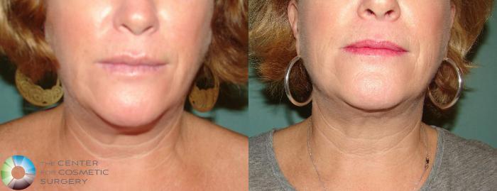 Before & After Neck Lift Case 650 View #3 View in Golden, CO