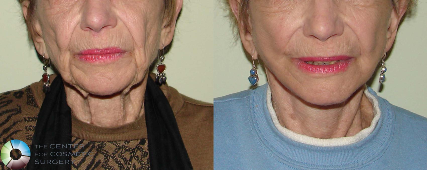 Before & After Facelift Case 665 View #1 in Denver and Colorado Springs, CO