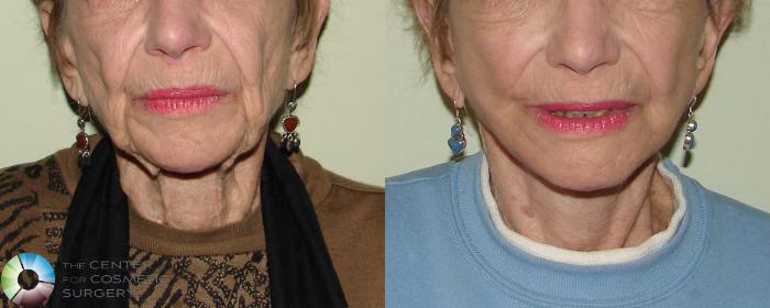 Before & After Neck Lift Case 665 View #1 View in Golden, CO