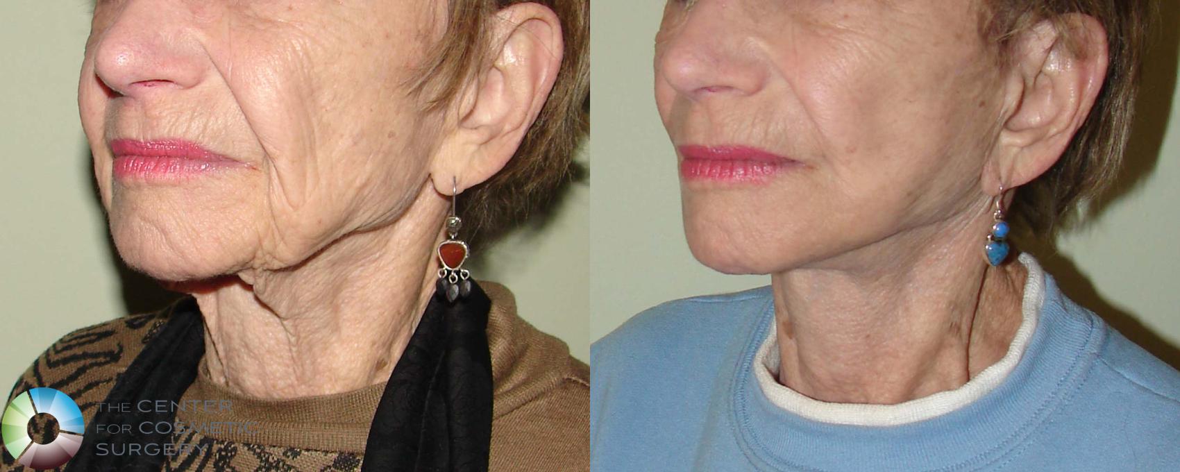 Before & After Mini Facelift Case 665 View #2 View in Denver & Golden, CO