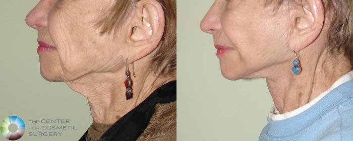 Before & After Neck Lift Case 665 View #3 View in Golden, CO