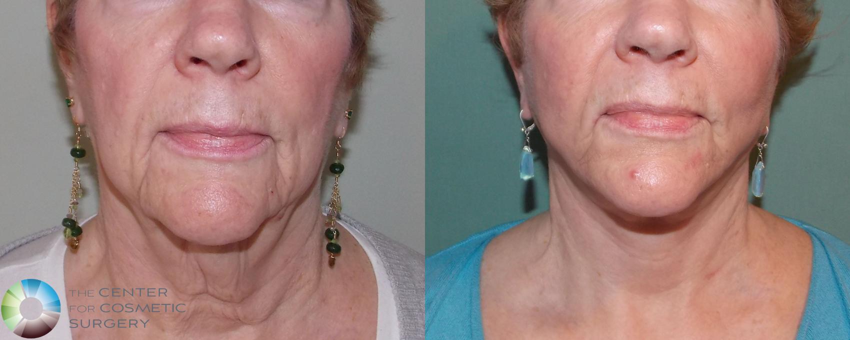 Before & After Neck Lift Case 691 View #1 in Denver and Colorado Springs, CO