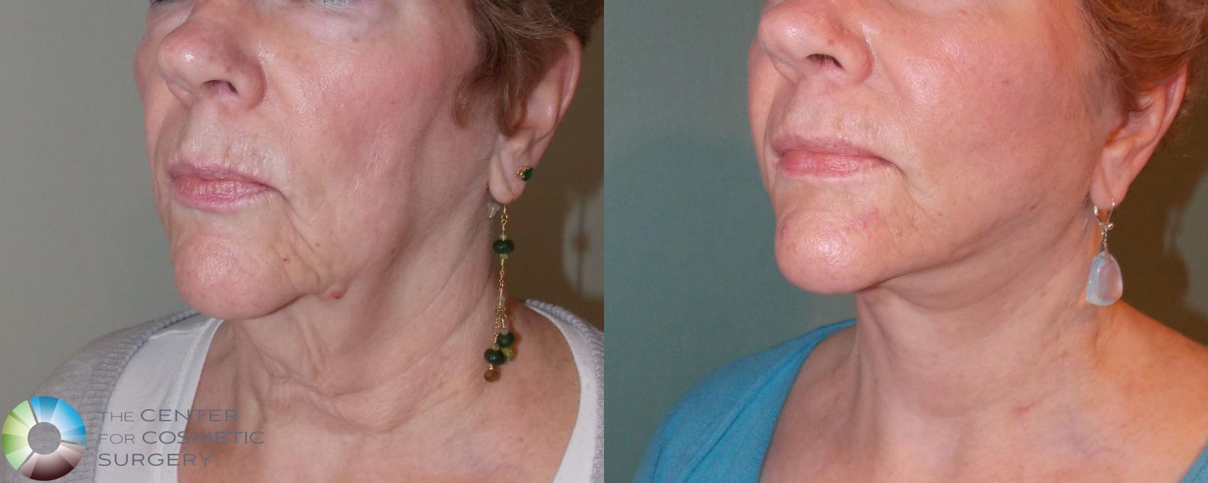 Before & After Neck Lift Case 691 View #2 View in Denver & Golden, CO