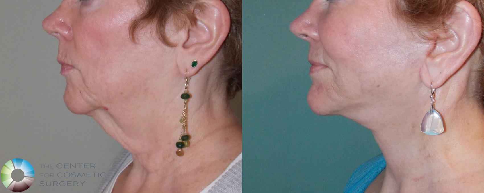 Before & After Neck Lift Case 691 View #3 View in Denver & Golden, CO