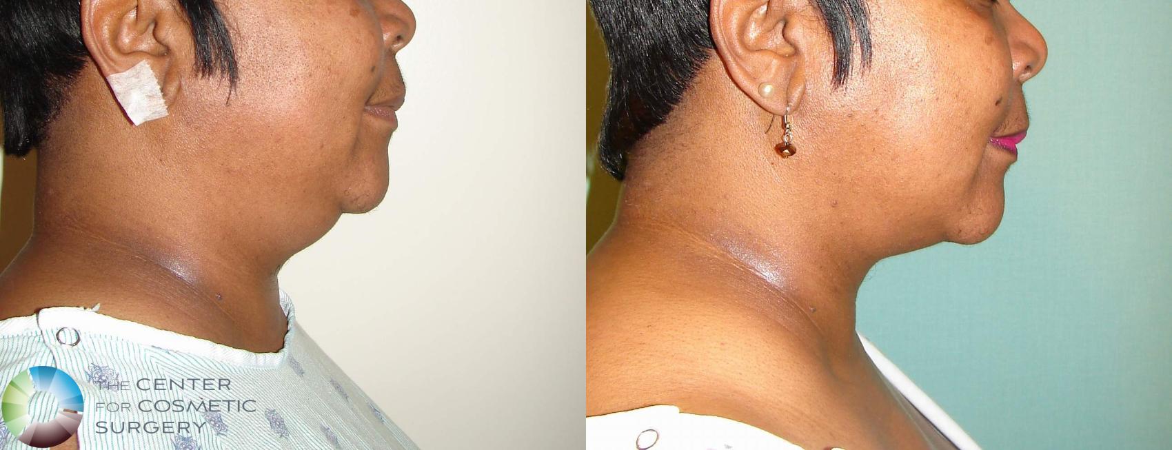 Before & After Liposuction Case 733 View #1 in Denver and Colorado Springs, CO