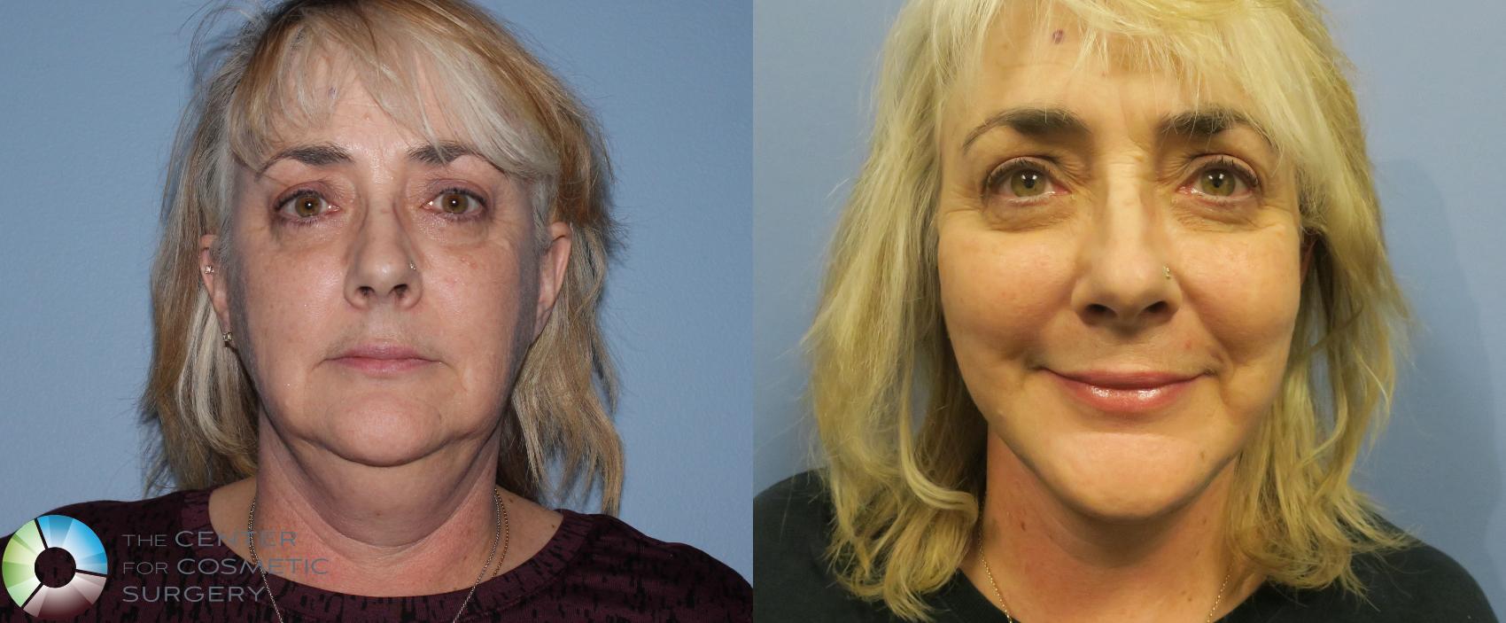 Before & After Facelift Case 770 View #1 in Denver and Colorado Springs, CO