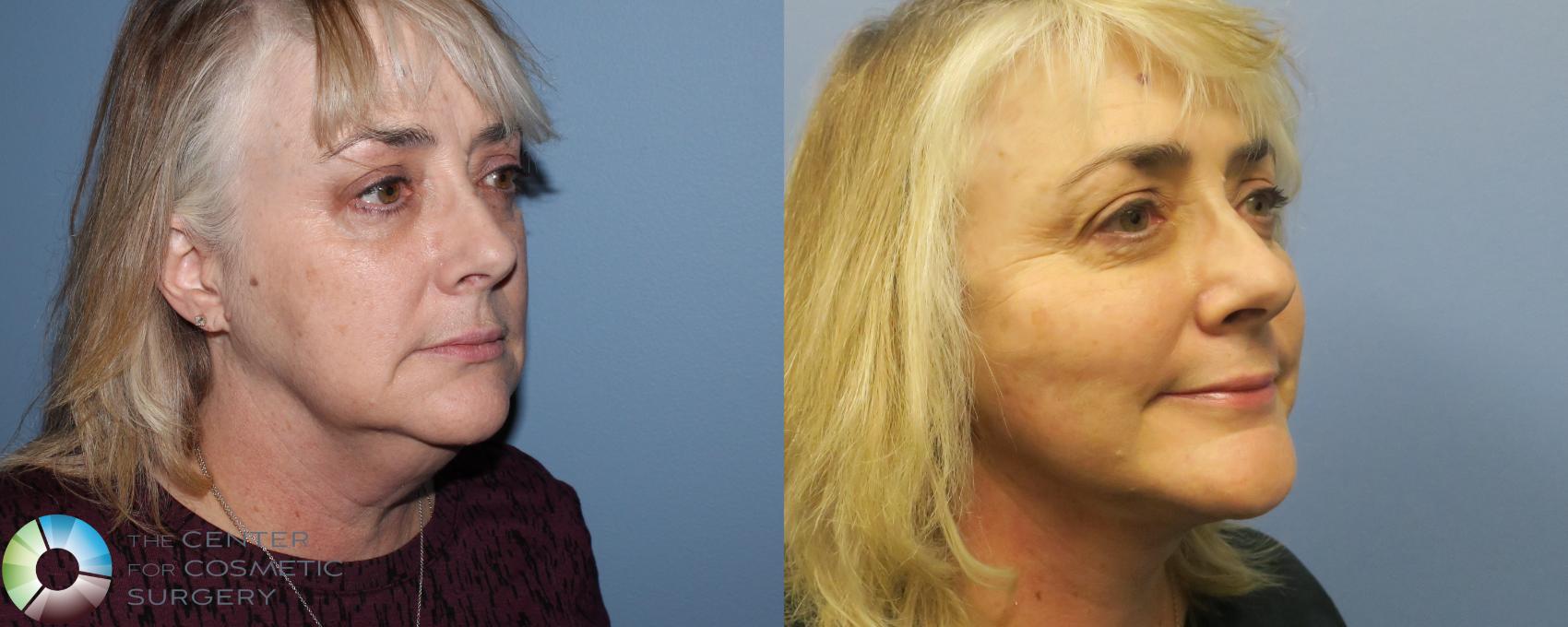 Before & After Neck Lift Case 770 View #2 View in Denver & Golden, CO