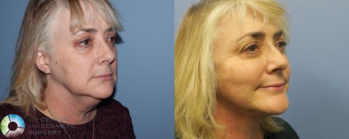 Before & After Neck Lift Case 770 View #2 View in Golden, CO