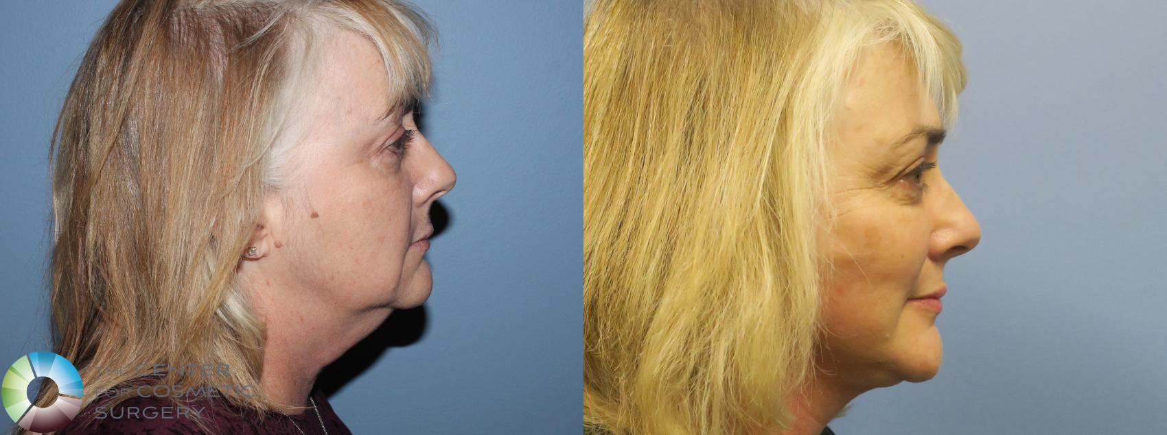 Before & After Mini Facelift Case 770 View #3 View in Denver & Golden, CO