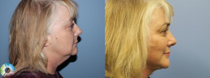 Before & After Neck Lift Case 770 View #3 View in Golden, CO