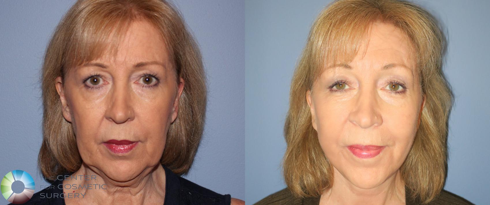 Before & After Facelift Case 810 View #1 in Denver and Colorado Springs, CO