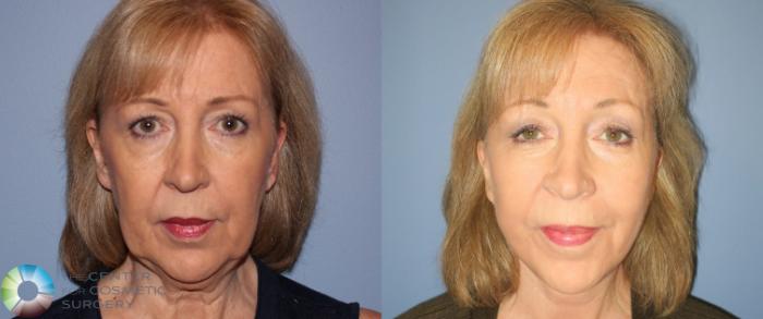 Before & After Neck Lift Case 810 View #1 View in Golden, CO