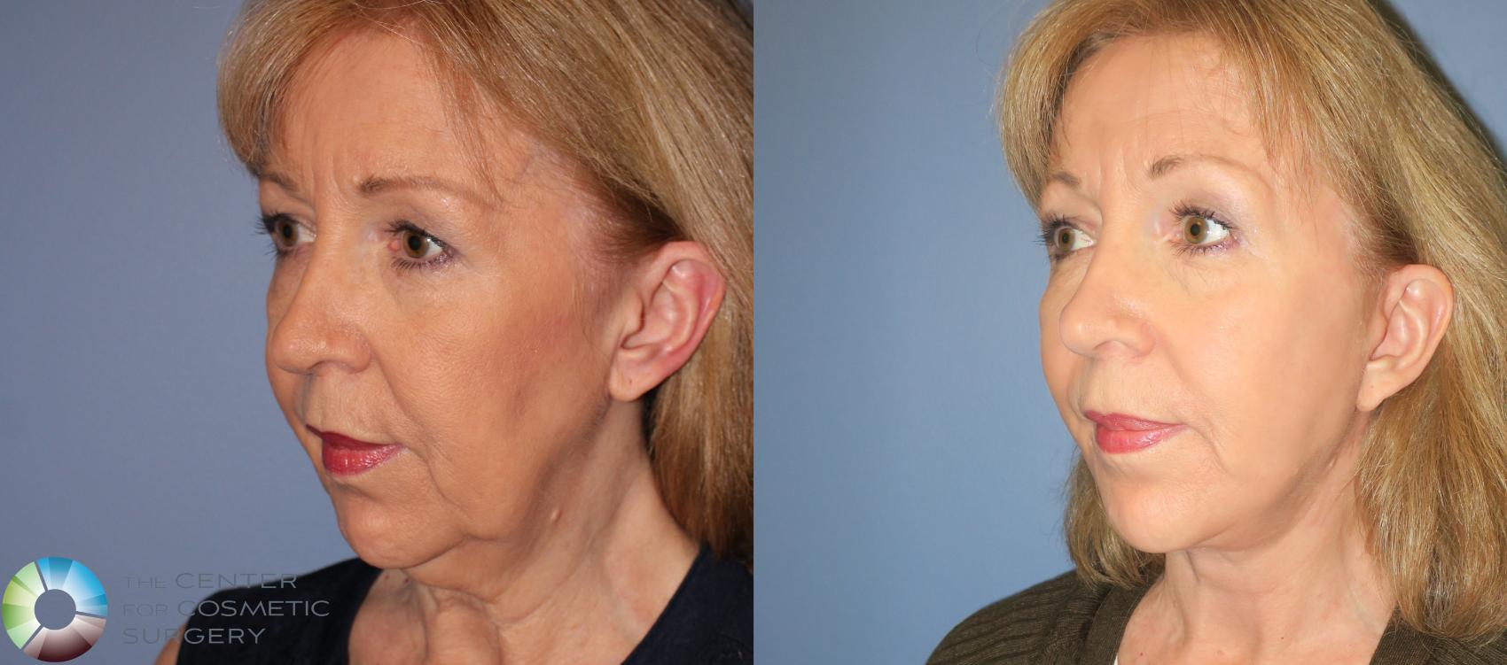 Before & After Neck Lift Case 810 View #2 View in Golden, CO