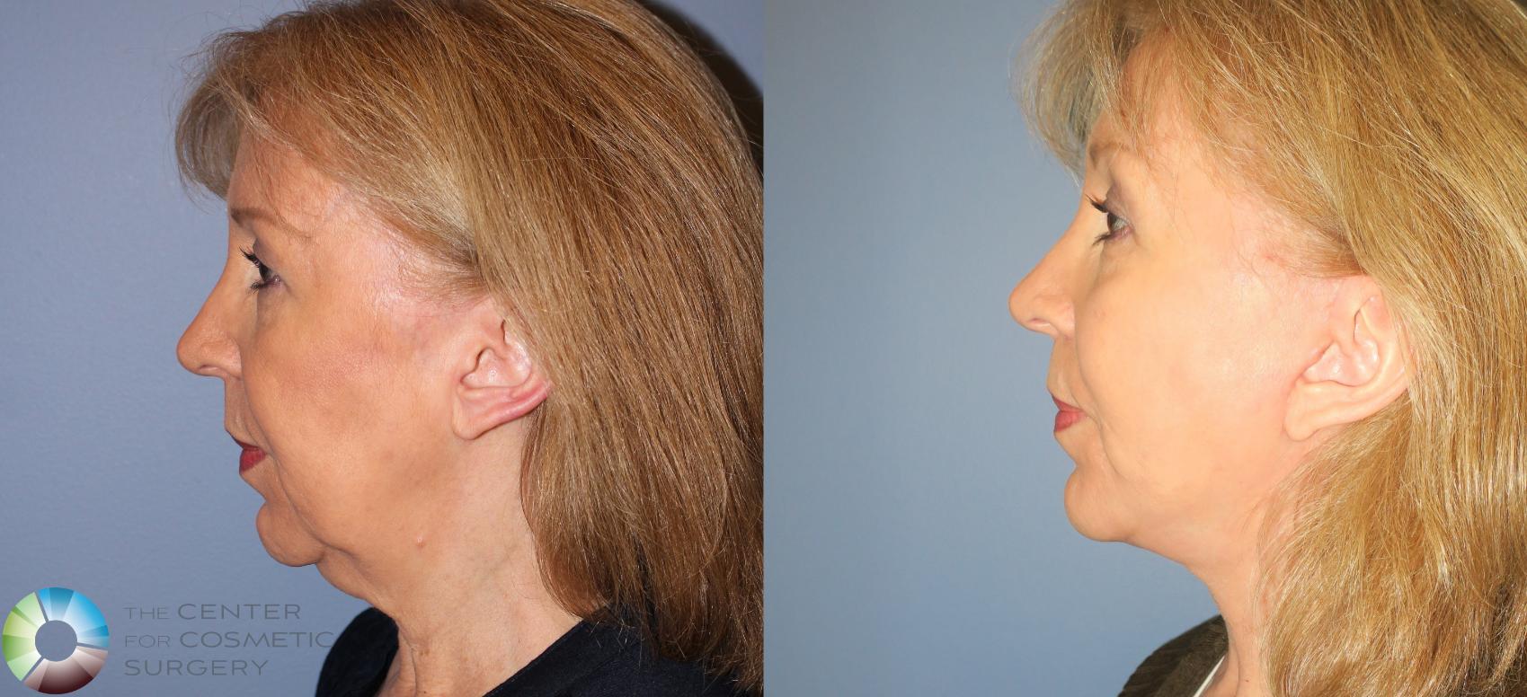 Before & After Neck Lift Case 810 View #3 View in Denver & Golden, CO