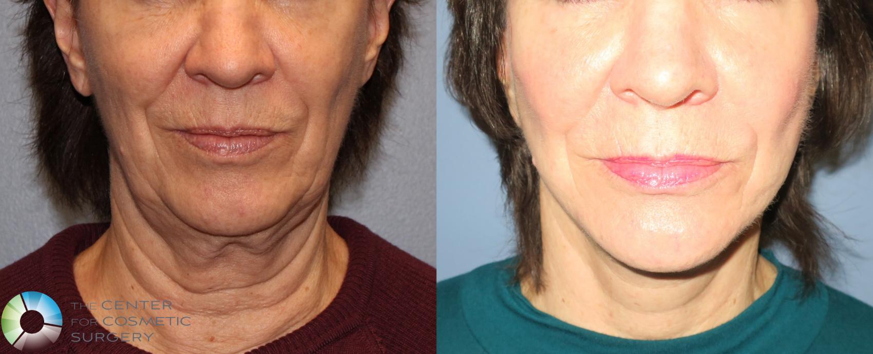 Facelift & Neck Lift in Denver, CO