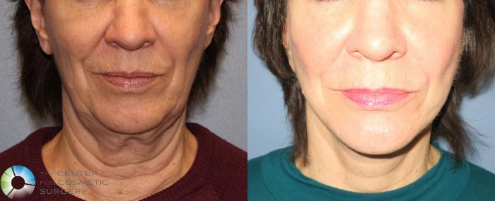 Before & After Neck Lift Case 822 View #1 View in Golden, CO