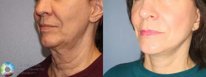 Neck Lift Before and After Pictures Case 822, Golden, CO