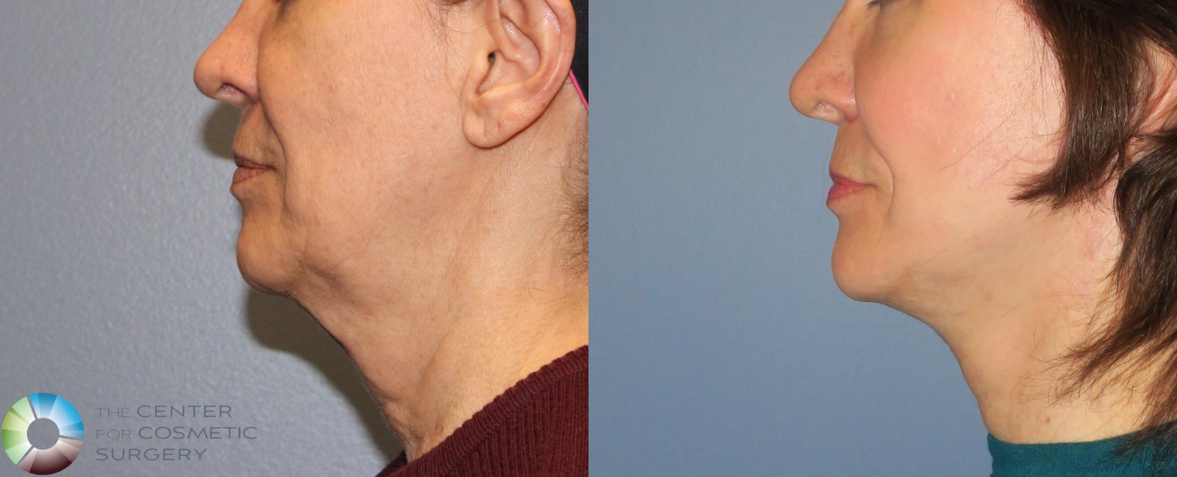 Before & After Neck Lift Case 822 View #3 View in Golden, CO