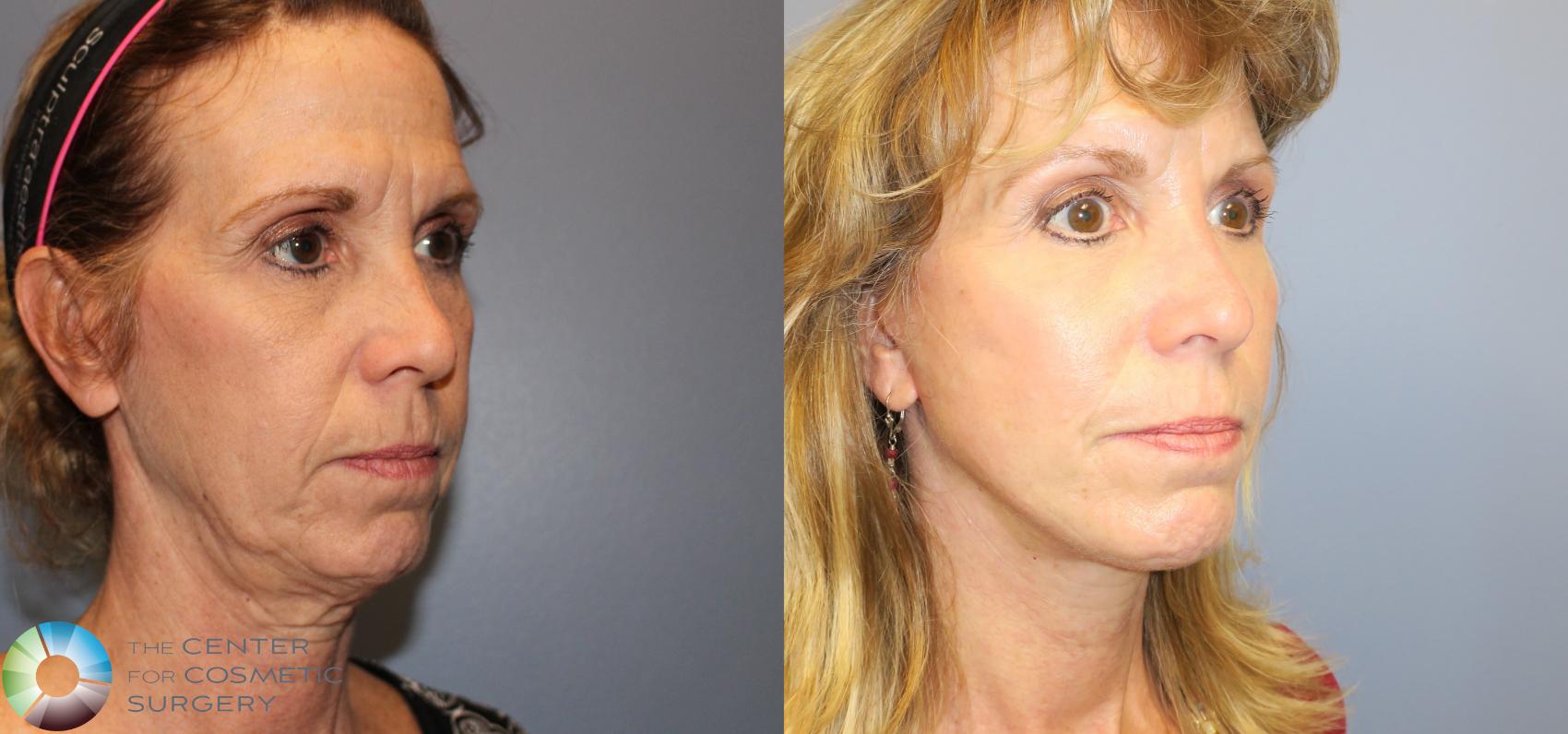 Before & After Mini Brow Lift Case 826 View #1 in Denver and Colorado Springs, CO